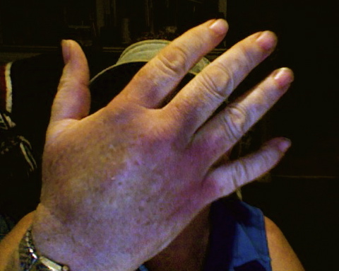 This was taken a week after my hand got smashed by a sheep.  The swelling is almost gone.