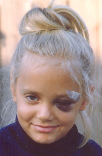 Becca had a close encounter with the concrete edge of the swimming pool!